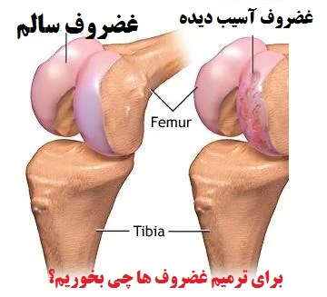 تقویت غضروف زانو با غضروف ساز خانگی و طبیعی