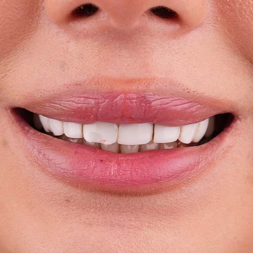 اگر لمینت دندان آسیب ببیند چه باید کرد؟ | نکات مهم قبل از لمینت دندان در مشهد