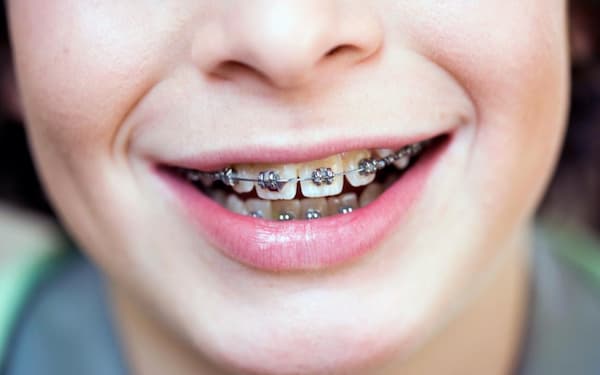 آیا ارتودنسی باعث پوسیدگی دندان میشود یا نه؟