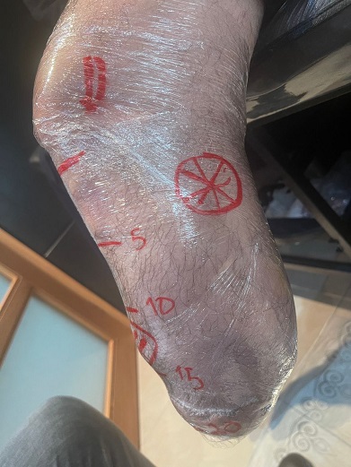 کاهش هزینه قطع پای دیابتی