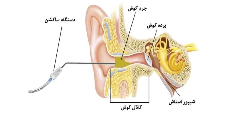 شستشوی گوش با آب بهتر است یا ساکشن